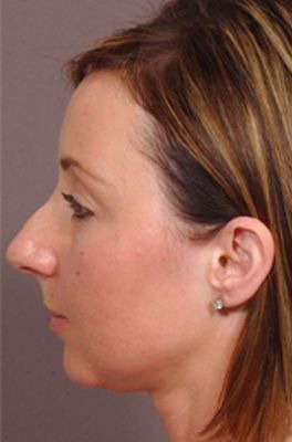 Rhinoplasty (Nose Job)