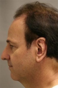 Otoplasty Result Pasadena