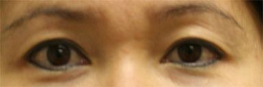 Blepharoplasty (Eyelid Lift and Eye Bag surgery)