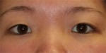 Blepharoplasty (Eyelid Lift and Eye Bag surgery)