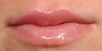 Lip Augmentation