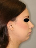 Rhinoplasty (Nose Job)