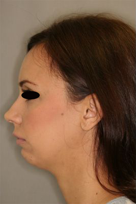 Rhinoplasty (Nose Job)