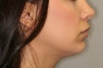 Rhinoplasty (Nose Job)