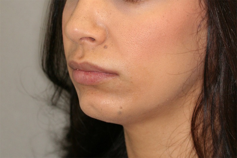 Rhinoplasty (Nose Job)