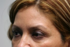 Brow Lift Results Pasadena
