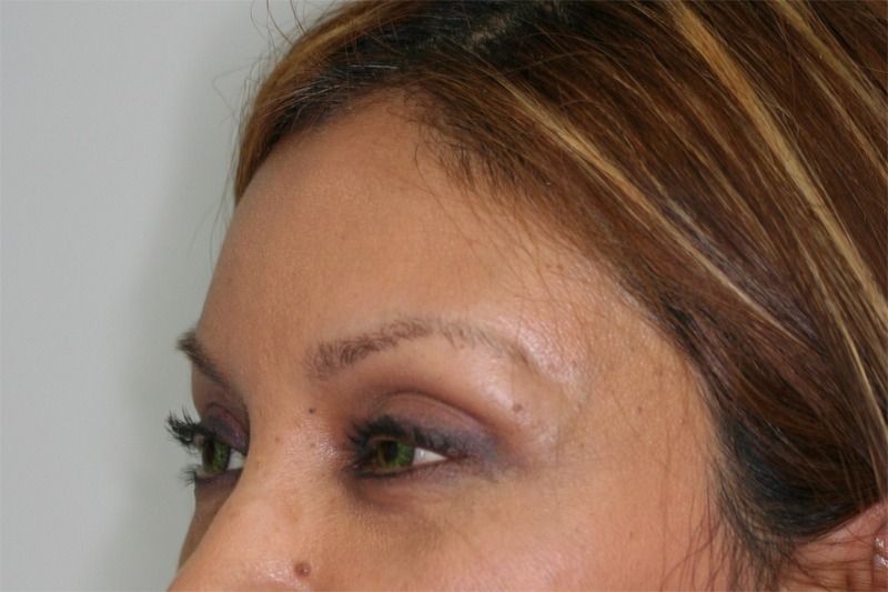 Brow Lift