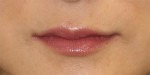 Lip Augmentation