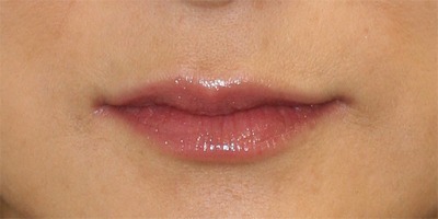 Lip Augmentation