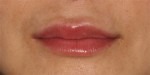 Lip Augmentation