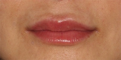 Lip Augmentation