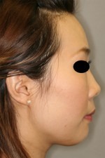 Rhinoplasty (Nose Job)