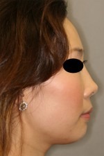 Rhinoplasty (Nose Job)