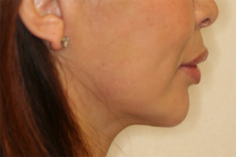 Chin Implant