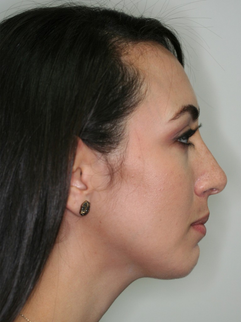 Chin Implant