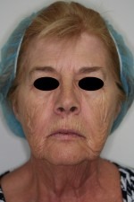 Facelift/Necklift