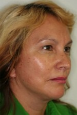 Facelift/Necklift