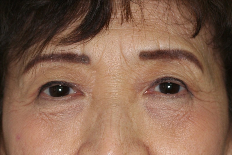 Blepharoplasty (Eyelid Lift and Eye Bag surgery)