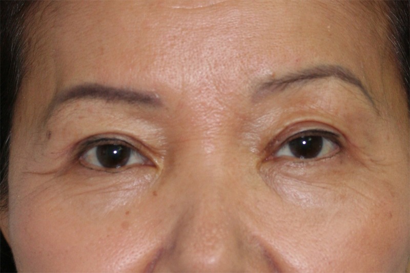 Blepharoplasty (Eyelid Lift and Eye Bag surgery)