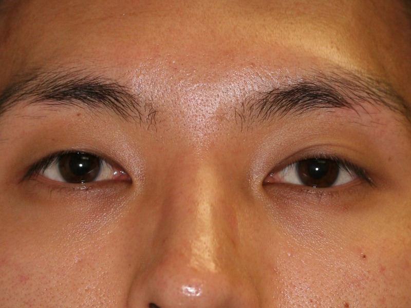 Blepharoplasty (Eyelid Lift and Eye Bag surgery)