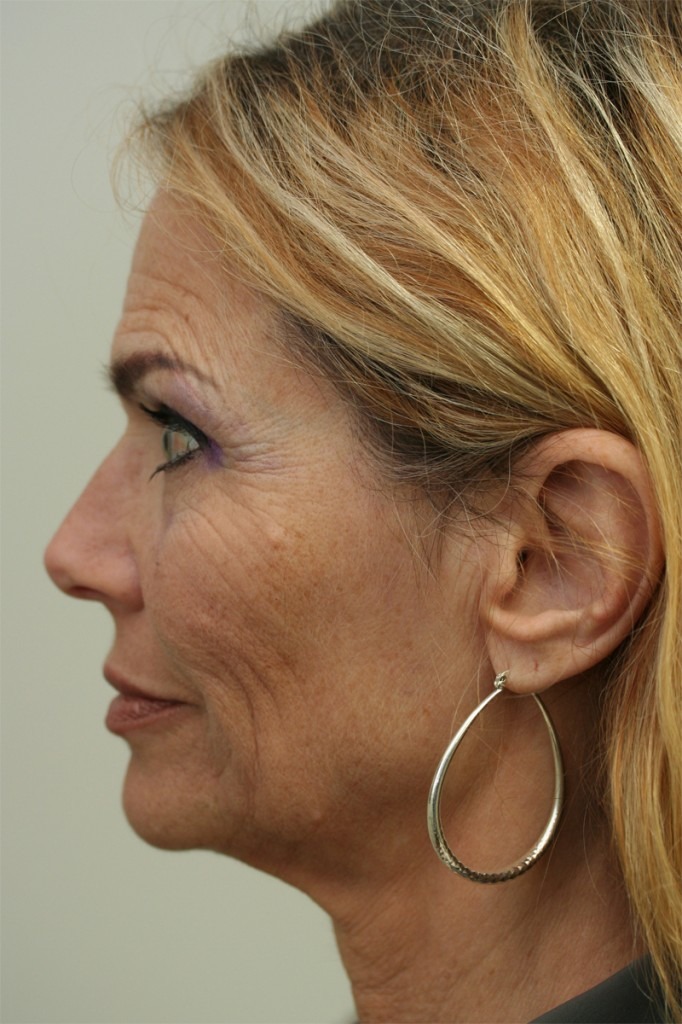 Facelift/Necklift