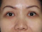 Blepharoplasty (Eyelid Lift and Eye Bag surgery)