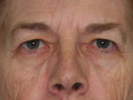 Blepharoplasty (Eyelid Lift and Eye Bag surgery)