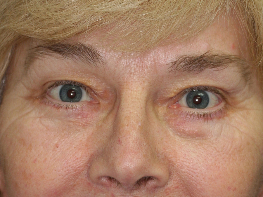 Blepharoplasty (Eyelid Lift and Eye Bag surgery)