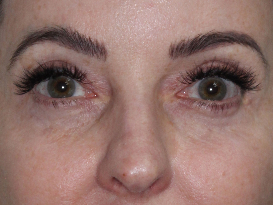 Blepharoplasty (Eyelid Lift and Eye Bag surgery)