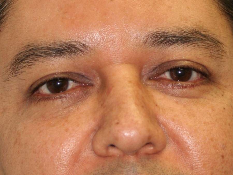 Blepharoplasty (Eyelid Lift and Eye Bag surgery)