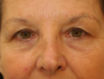 Blepharoplasty (Eyelid Lift and Eye Bag surgery)