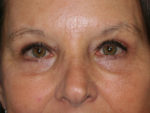 Blepharoplasty (Eyelid Lift and Eye Bag surgery)