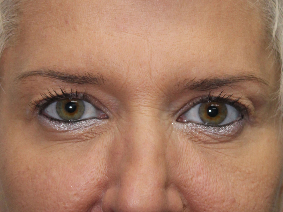 Blepharoplasty (Eyelid Lift and Eye Bag surgery)