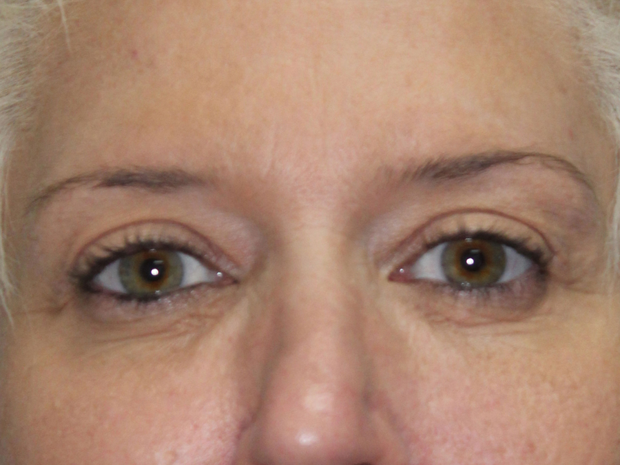 Blepharoplasty (Eyelid Lift and Eye Bag surgery)