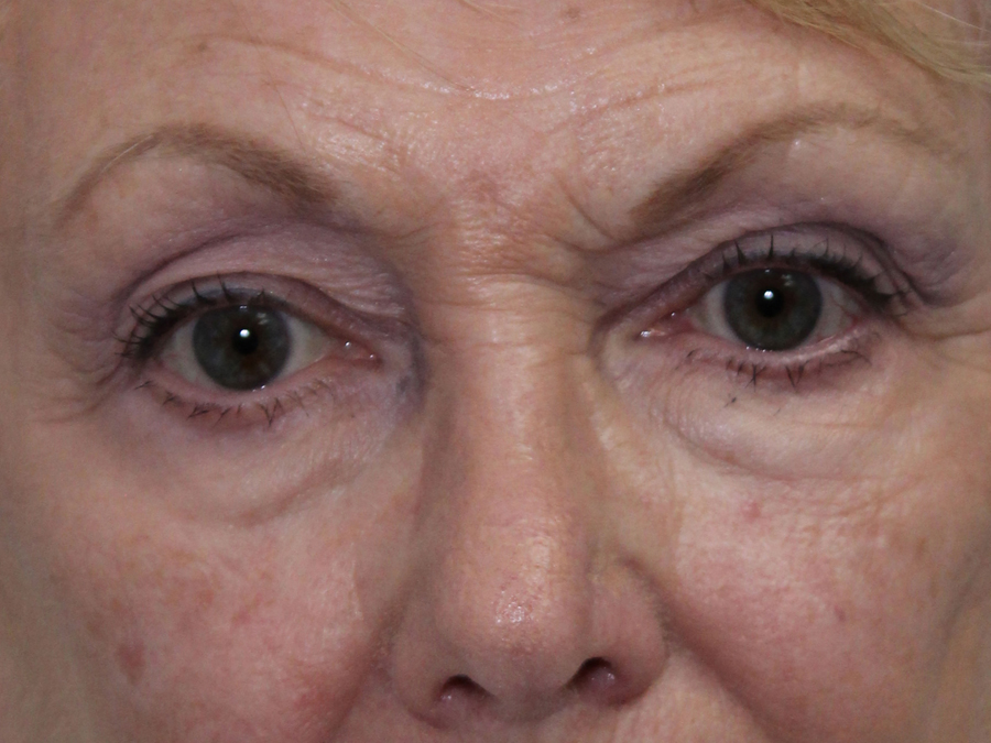 Blepharoplasty (Eyelid Lift and Eye Bag surgery)