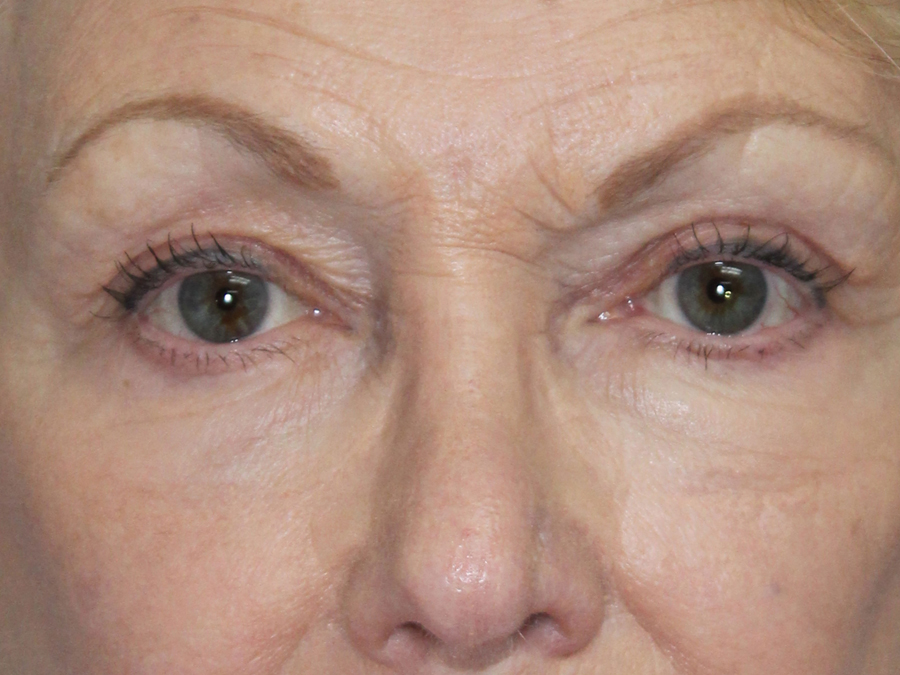 Blepharoplasty (Eyelid Lift and Eye Bag surgery)