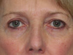 Blepharoplasty (Eyelid Lift and Eye Bag surgery)