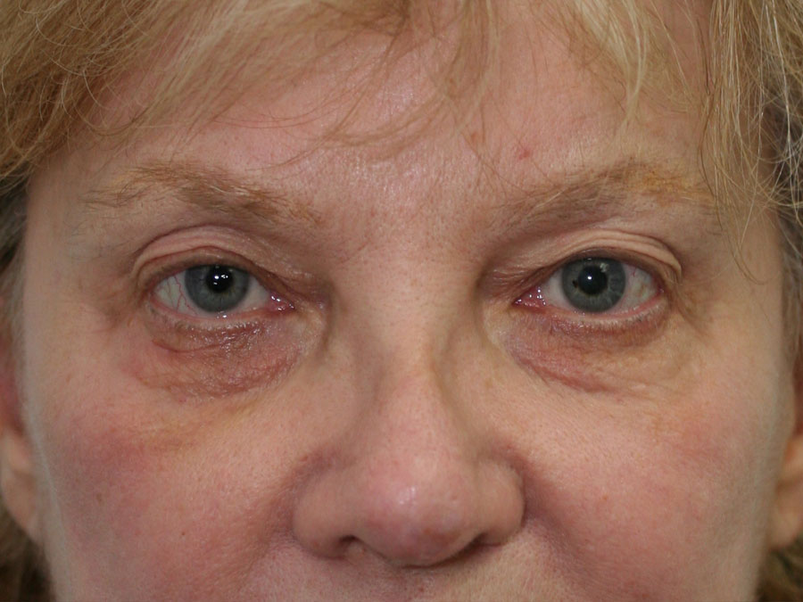 Blepharoplasty (Eyelid Lift and Eye Bag surgery)