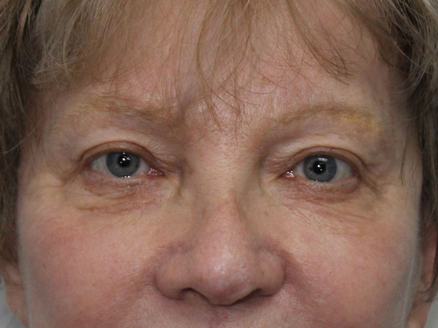 Blepharoplasty (Eyelid Lift and Eye Bag surgery)