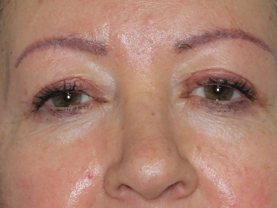 Blepharoplasty (Eyelid Lift and Eye Bag surgery)