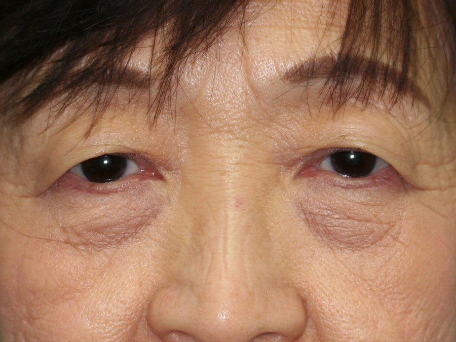 Blepharoplasty (Eyelid Lift and Eye Bag surgery)