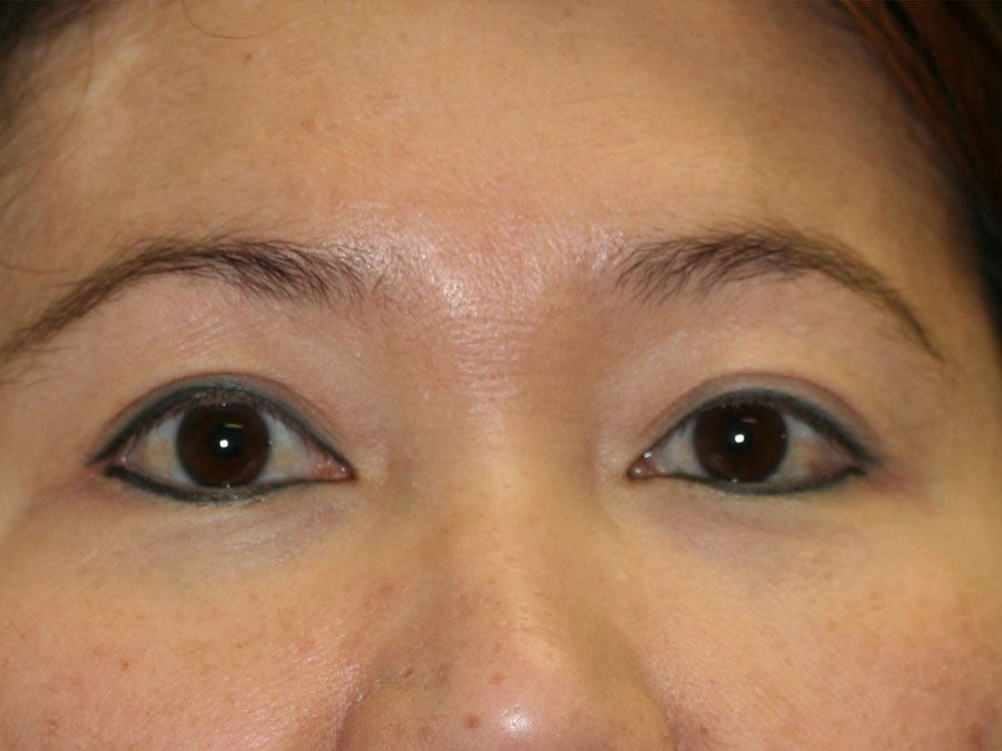 Blepharoplasty (Eyelid Lift and Eye Bag surgery)