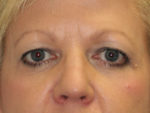 Blepharoplasty (Eyelid Lift and Eye Bag surgery)