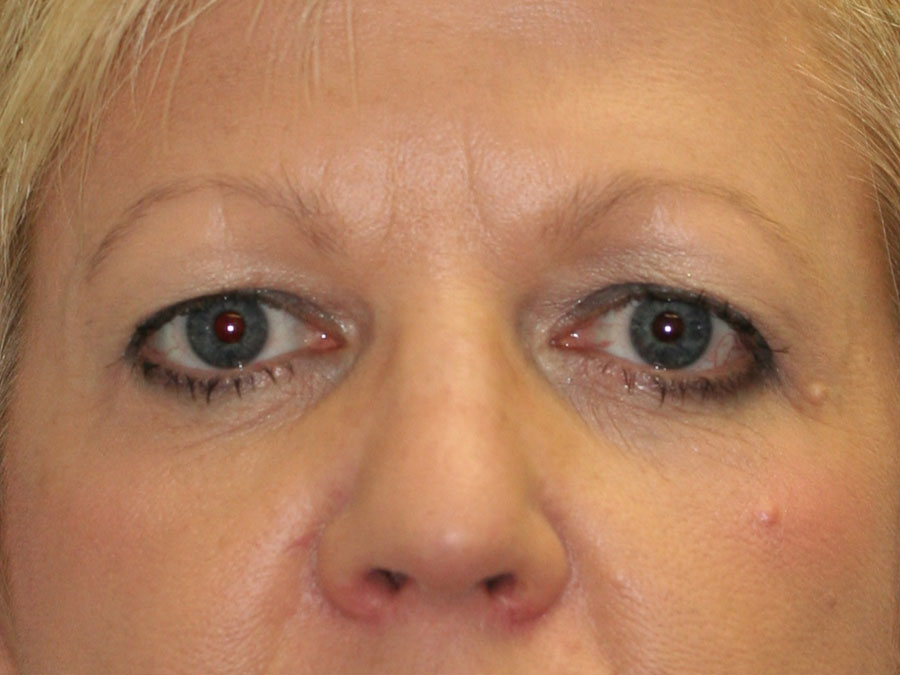 Blepharoplasty (Eyelid Lift and Eye Bag surgery)