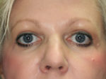 Blepharoplasty (Eyelid Lift and Eye Bag surgery)