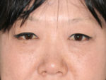 Blepharoplasty (Eyelid Lift and Eye Bag surgery)