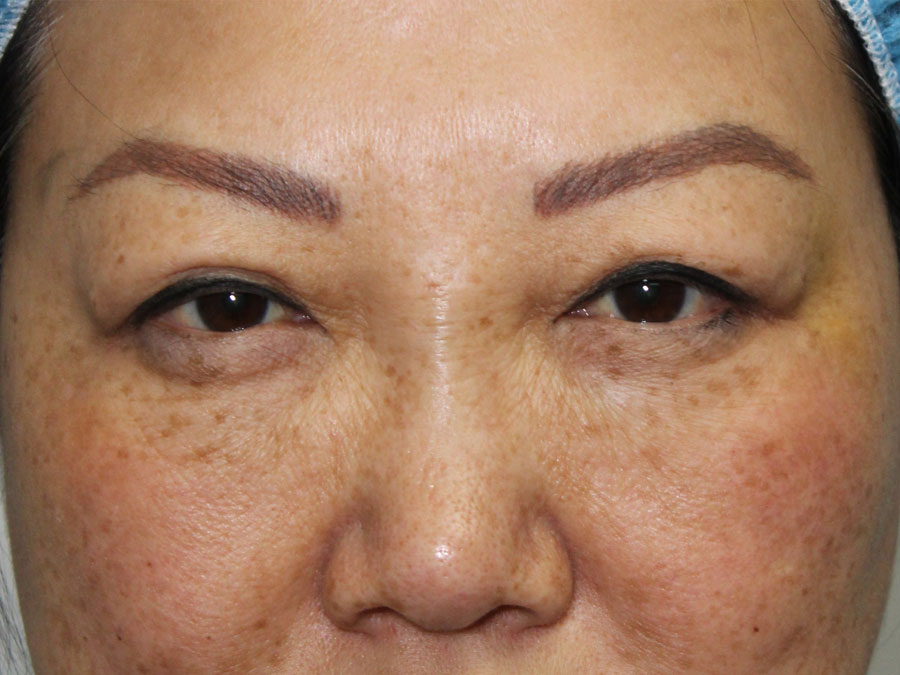 Blepharoplasty (Eyelid Lift and Eye Bag surgery)