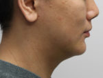 Chin Implant