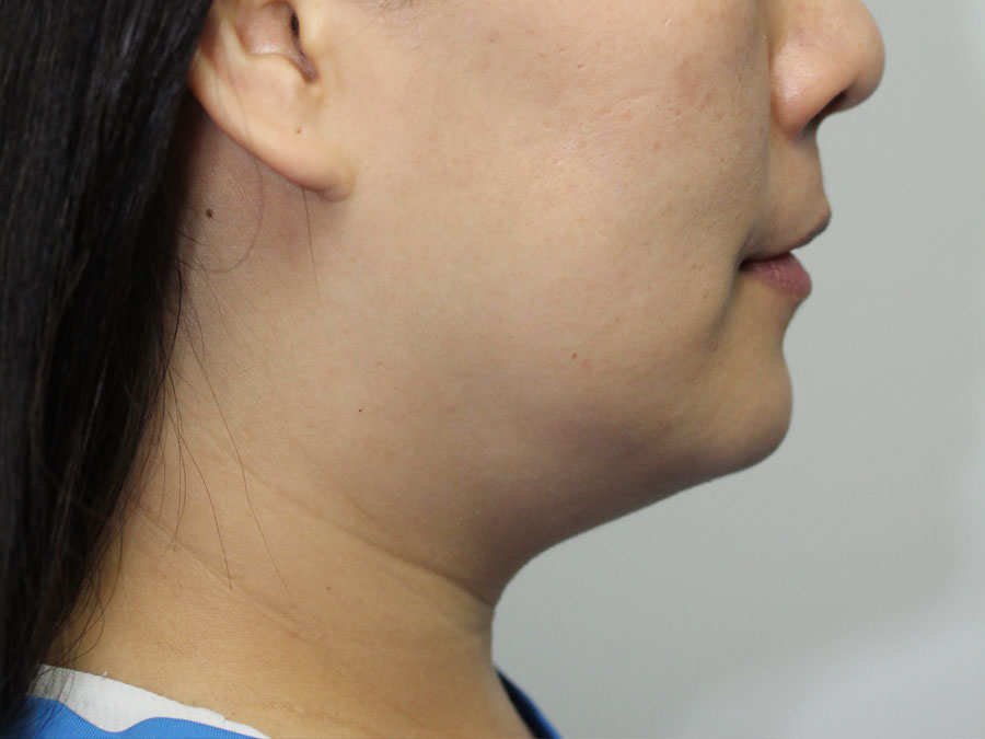 Chin Implant