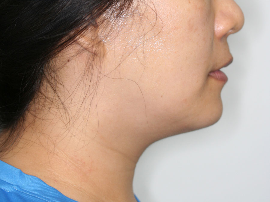 Chin Implant